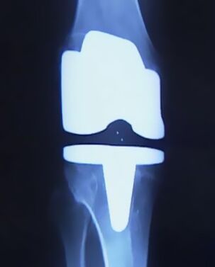 X -RRay биргелешип өзгөртүү үчүн жасалма протез менен тизедин сүрөтү